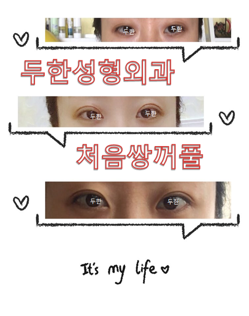[두한성형외과 눈재수술] - [부분절개법 재수술] 관련 이미지 43
