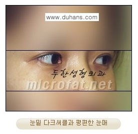 [두한성형외과 경쟁력 눈밑성형] - [눈밑 애교살 시술을 위한 미세지방이식] 관련 이미지 2