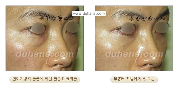 [두한성형외과 젊은 눈매 안검성형] - [눈밑 지방제거의 수술 전후 안내 ①] 관련 이미지 11