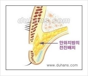 [두한성형외과 경쟁력 쌍꺼풀 재수술, 극한 눈재수술] - [쌍꺼풀 재수술, 눈재수술 실패의 원인 안내] 관련 이미지 4