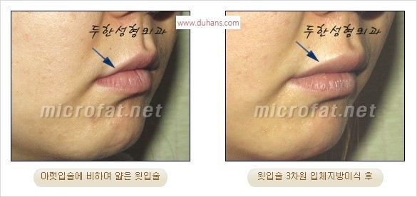 ​​[두한성형외과 경쟁력 미세지방이식] - [볼륨감 있는 입술성형] 관련 이미지 19