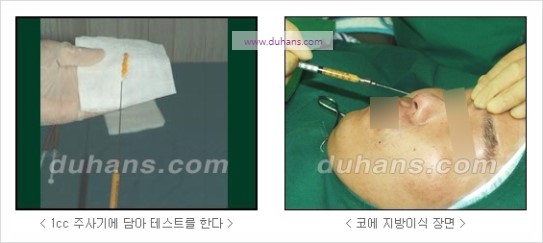 [두한성형외과 경쟁력 코성형] - [코를 높히는 지방이식] 관련 이미지 7