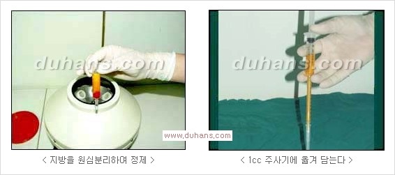 [두한성형외과 경쟁력 눈밑성형] - [밝고 젊게 보이는 눈밑 애교살 미세지방이식] 관련 이미지 2