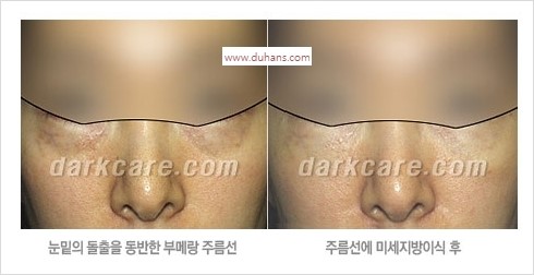 [두한성형외과 경쟁력 눈밑성형] - [눈밑 안와지방 돌출의 무통마취 무흉터 눈밑지방제거 안내] 관련 이미지 11