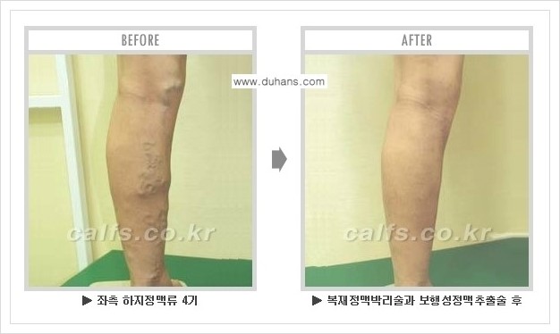 [두한성형외과 경쟁력 멀티종아리성형] - [하지정맥류 치료 안내] 관련 이미지 13