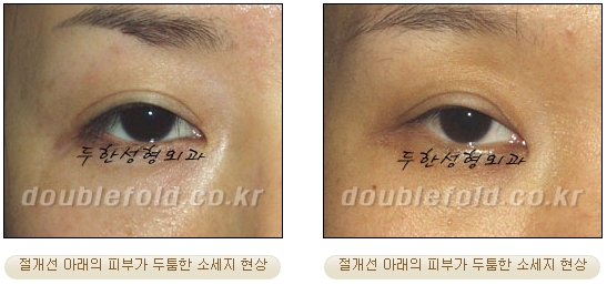 [두한성형외과 쌍커풀재수술] - [심한 소세지눈, 두줄따기, 쌍꺼풀 흉터] 관련 이미지 32