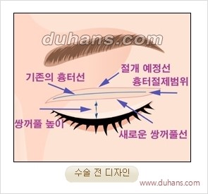 [두한성형외과 경쟁력 눈성형] - [완전절개법(Full incision method)의 재수술 과정] 관련 이미지 1