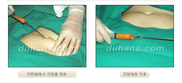 ✨눈 위 꺼짐, 단순 미용이 아닌 기능까지 고려해야 하는 이유✨ 관련 이미지 4
