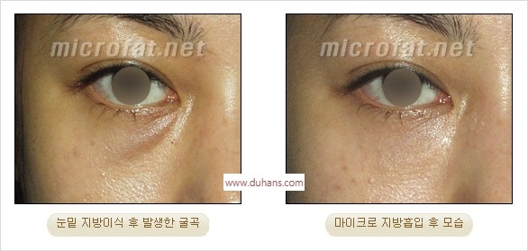 [두한성형외과 경쟁력 미세지방이식] - [지방이식 부작용 교정 모습 안내] 관련 이미지 22