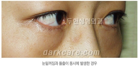 두한성형외과 눈밑성형 - 눈밑지방제거, 눈밑주름, 눈밑지방재배치 관련 이미지 96