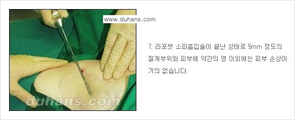 [두한성형외과 성형 FOCUS 지방흡입] - [액취증 - 다한증 초음파 컷터 지방흡입 ④] 관련 이미지 8