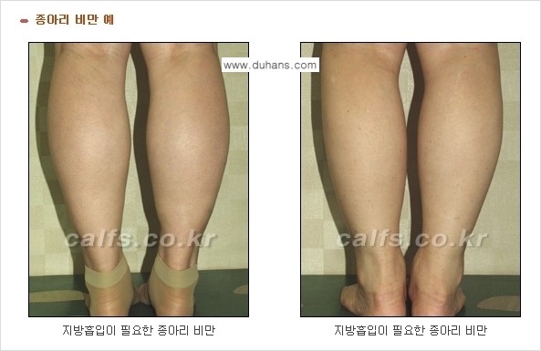 [두한성형외과 경쟁력 종아리성형] - [종아리 지방흡입 1.] 관련 이미지 2