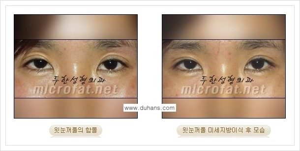 [두한성형외과의 경쟁력 미세지방이식] - [꺼진 눈꺼풀(윗눈꺼풀 함몰) 미세지방이식 안내] 관련 이미지 8