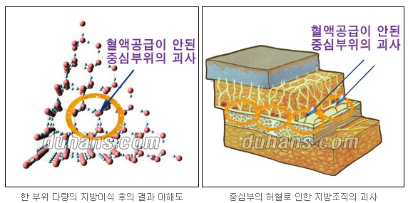 [두한성형외과 주름교정] - [주름개선 지방이식] 관련 이미지 3
