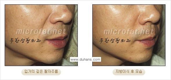 [두한성형외과 경쟁력 미세지방이식] - [입가주름, 팔자주름 미세지방이식 안내 ②] 관련 이미지 5