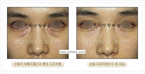 [두한성형외과 경쟁력 눈밑성형] - [꺼진 눈밑, 눈밑 함몰 주름선 눈밑 미세지방이식 안내] 관련 이미지 26