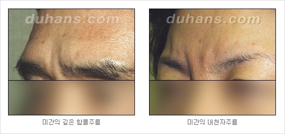 [Dr. 컬럼] - [주름교정을 위한 미세지방이식] 관련 이미지 1