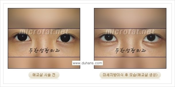 [두한성형외과 경쟁력 눈밑성형] - [애교살과 다크써클과의 관계] 관련 이미지 13
