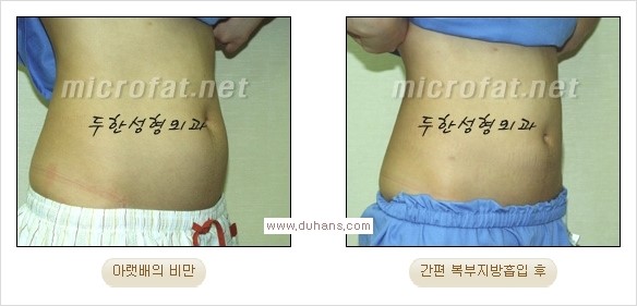 [두한성형외과 경쟁력 지방흡입] - [초음파 지방흡입과 미세흡입관을 이용한 간편지방흡입] 관련 이미지 9