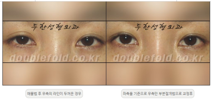 [두한성형외과 쌍커플재수술] - [비대칭 쌍커풀 라인] 관련 이미지 5