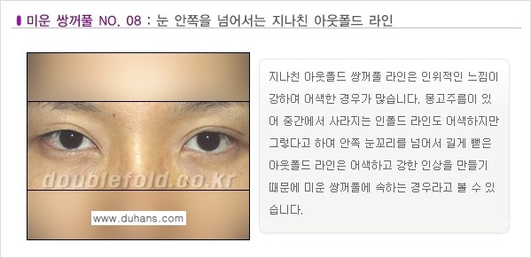 [두한성형외과 경쟁력 눈성형] - [미운 쌍꺼풀이란?] 관련 이미지 9
