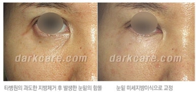 [두한성형외과 다크서클 수술방법] - [NO흉터 눈밑지방제거] 관련 이미지 18