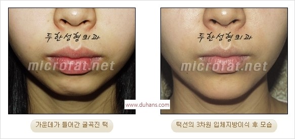 [두한성형외과 경쟁력 안면윤곽 교정] - [자연스럽고 균형있는 턱으로의 복원 미세지방이식과 간편 사각턱 보톡스 안내] 관련 이미지 15
