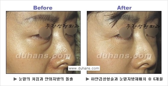 [두한성형외과의 상큼하고 환한 젊은 눈매완성] - [하안검 성형술 ①] 관련 이미지 24