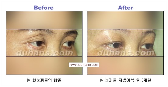 [두한성형외과 경쟁력 안검성형] - [젊고 아름다운 눈매 상안검 성형술 안내] 관련 이미지 8