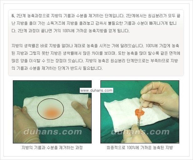 [두한성형외과 경쟁력 미세지방이식] - [부드럽고 아름다운 얼굴선 만들기, 얼굴 미세지방이식 과정 안내] 관련 이미지 5