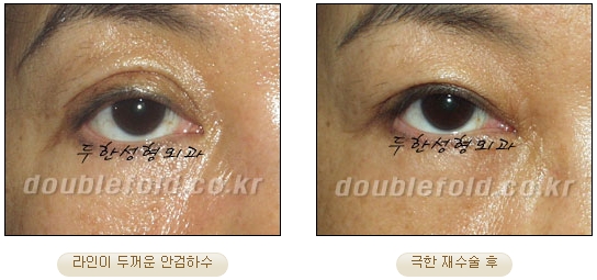 [DoubleFold Plastic Surgery Eye Surgery] - [Revision Surgery for Thick Double Eyelids] image 36