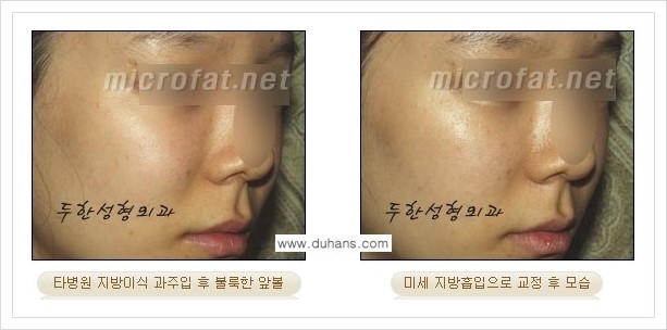[두한성형외과의 경쟁력 지방이식] - [볼살 지방이식 부작용 -  지방이식 후 과주입으로 인해 불룩해진 경우] 관련 이미지 3