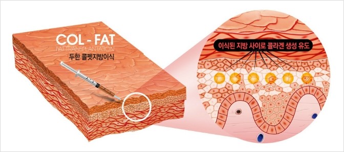[두한성형외과 경쟁력 눈밑성형] - [눈밑에 사선의 함몰주름선이 진하게 있는 다크써클 치료방법] 관련 이미지 4
