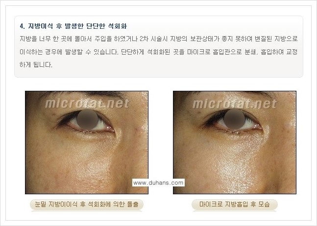 [두한성형외과 경쟁력 지방이식] - [지방이식 부작용 교정 안내 2.] 관련 이미지 11