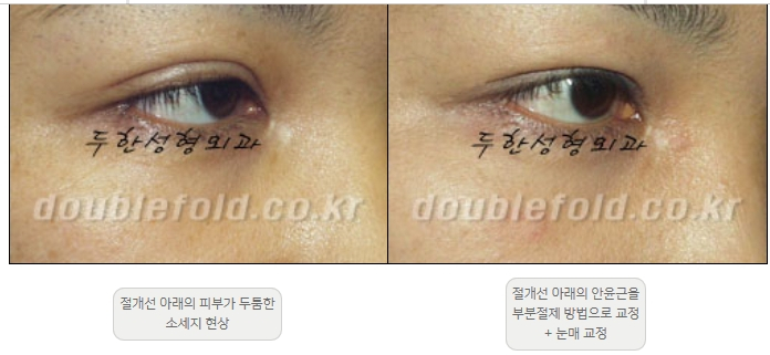 [Double Eyelid Surgery Duhan Plastic Surgery] - [Revision Methods] image 13