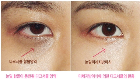 [두한성형외과 다크서클] - [콜펫지방이식] 관련 이미지 16