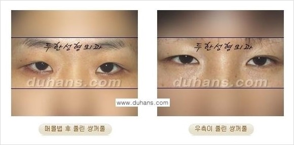 [두한성형외과 경쟁력 쌍꺼풀 재수술, 극한 재수술] - [풀려버린 쌍꺼풀 라인의 교정 방법 안내] 관련 이미지 2