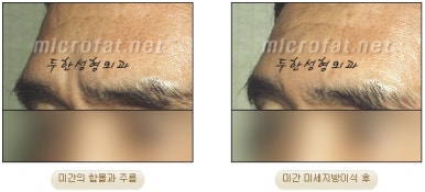 Fat Grafting Leader Duhan Plastic Surgery - Everything About Fat Grafting image 10