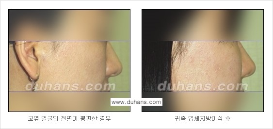 [두한성형외과 경쟁력 지방이식] - [귀족수술과 인디언밴드 윤곽성형] 관련 이미지 12