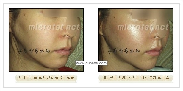 [두한성형외과 경쟁력 미세지방이식] - [볼살 지방이식 - 남자 야윈 볼살, 타병원 지방이식 후 굴곡 발생] 관련 이미지 11
