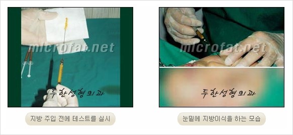 [두한성형외과 경쟁력 눈밑성형 리더] - [윗눈꺼풀 지방제거, 눈밑지방제거, 눈밑지방재배치, 눈밑지방이식 안내] 관련 이미지 18