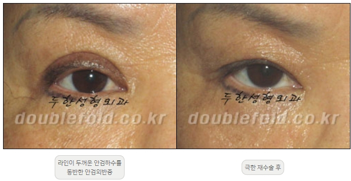 [Double Eyelid Surgery, Duhan Plastic Surgery] - [Extreme Revision Eye Surgery to Correct a Damaged Line] image 12