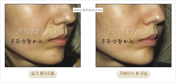 [두한성형외과 경쟁력 주름성형] - [코 옆과 입가에 걸쳐서 형성된 주름을 교정해주는 미세지방이식] 관련 이미지 11