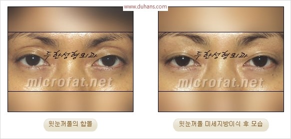 [두한성형외과 경쟁력 눈성형 리더] - [윗눈꺼풀 함몰( #꺼진눈꺼풀) 미세지방이식과 상안검성형]#꺼진눈성형 , #눈위함몰 관련 이미지 20