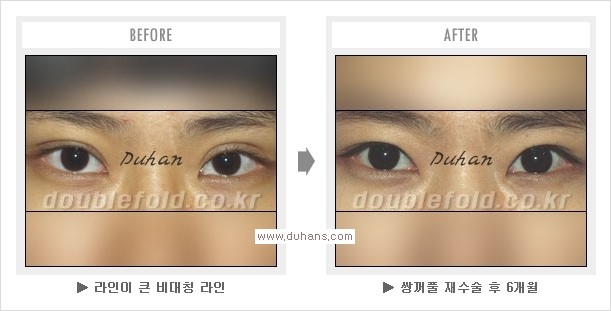 [두한성형외과 경쟁력 쌍꺼풀 재수술, 극한 눈재수술] - [망친 쌍꺼풀, 망가진 쌍꺼풀 복원수술, 재수술의 성공요건] 관련 이미지 13