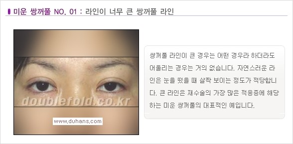 [두한성형외과 경쟁력 쌍꺼풀 재수술, 극한 재수술] - [일반적인 기준의 미운 쌍꺼풀과 아름다운 쌍꺼풀 안내] 관련 이미지 1