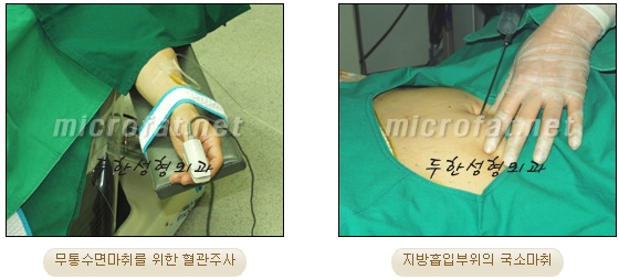 두한성형외과 지방흡입 - 부위별 안전 지방흡입 관련 이미지 3