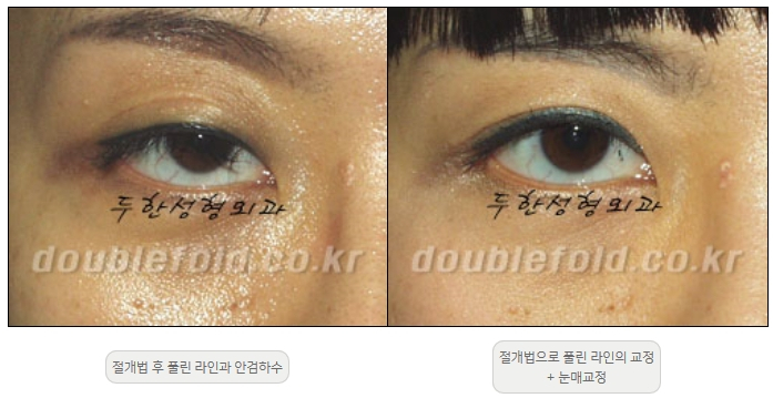 [두한성형외과 쌍커풀재수술] - [풀린 쌍커풀라인 교정] 관련 이미지 9
