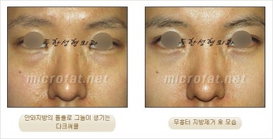 두한성형외과 눈밑수술 - 다크서클 수술 전후 관리 안내 관련 이미지 43