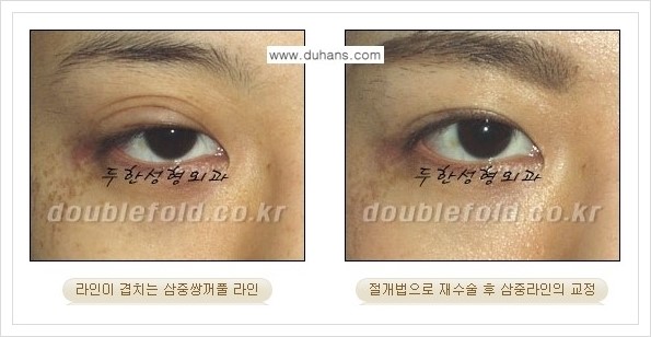 [두한성형외과 경쟁력 쌍꺼풀 재수술] - [삼중 쌍꺼풀 라인의 교정 안내] 관련 이미지 7